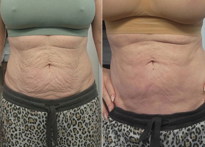 Abdomen before and after Vesper treatment
