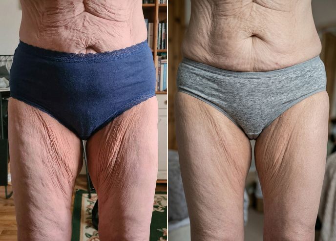Thighs before and after Vesper treatment